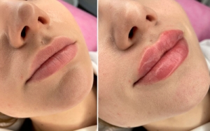 Качественная контурная пластика губ - выравнивание и увеличение губ