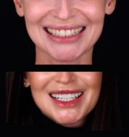 Качественные виниры в Киеве - стоматология Са-Ната