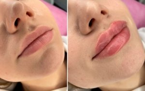 Качественная контурная пластика губ - выравнивание и увеличение губ