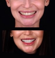 Качественные виниры в Киеве - стоматология Са-Ната