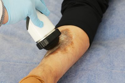 Лечение диабетической стопы ударно-волновой терапией в Запорожье